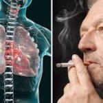 Lung-Cancer